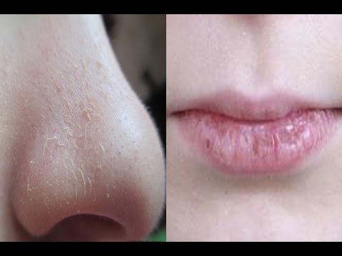 The skin on the face is dry and peeling - what to do, reasons, treatment
