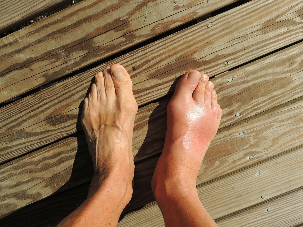 Photo of the affected foot with gout
