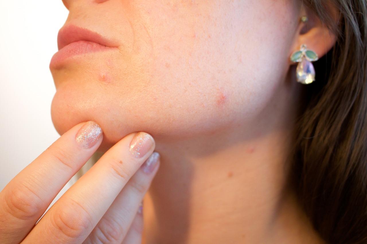 Symptoms and treatment of chickenpox in adults